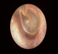 鼓膜（左耳）